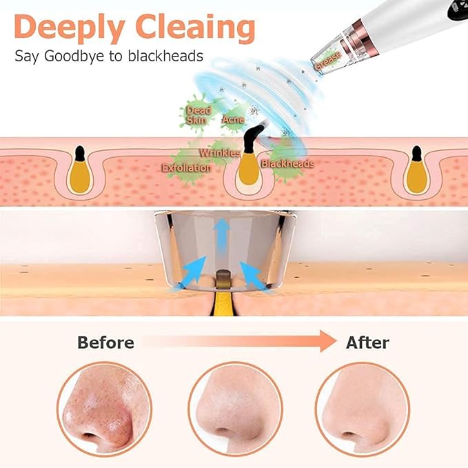 ClearSuctionix | Blackhead Remover Suction Machine Blackheads Removing Tool ClearSuctionix 6 In 1 Black & Whitehead Remover